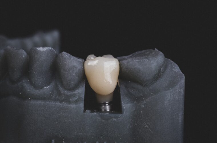 A ceramic dental crown alongside a model of the surrounding teeth