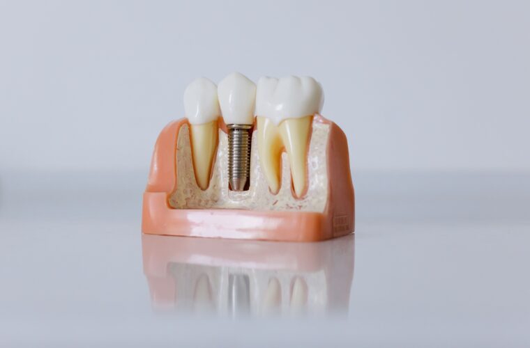 A model showing a dental implant in the jaw