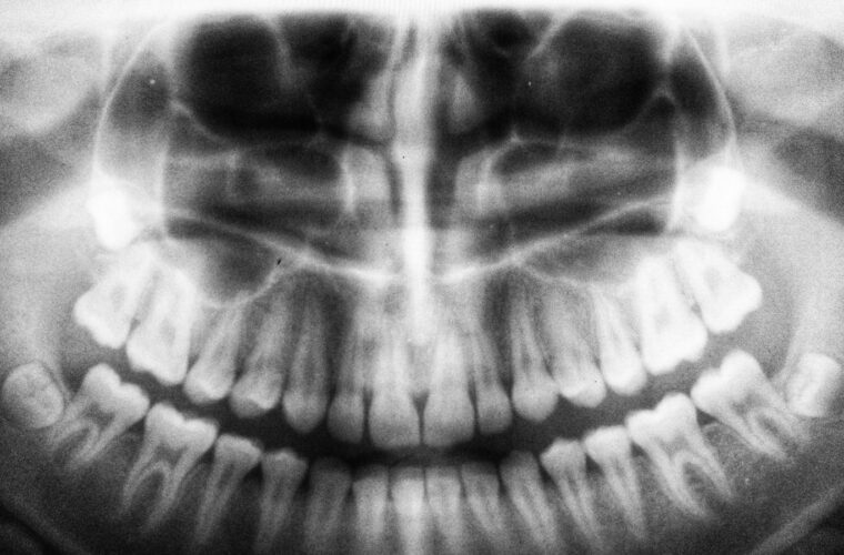 A panoramic dental radiograph showing the full upper and lower jaw
