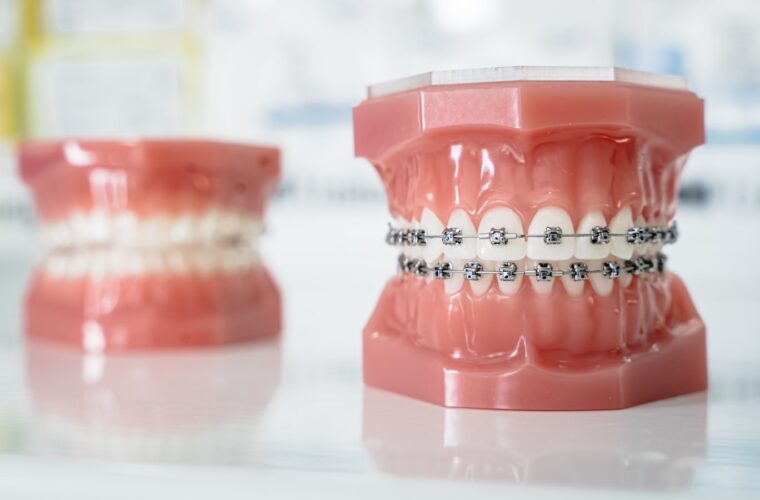 Traditional metal braces fitted across the upper teeth