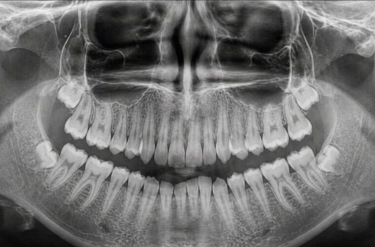 A dental X-ray showing wisdom teeth